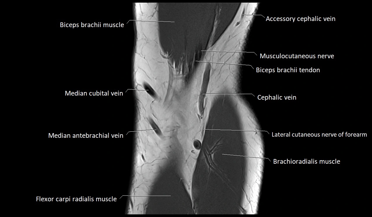 Elbow coronal anatomy image  cross sectional 3T MRI image 6.webp